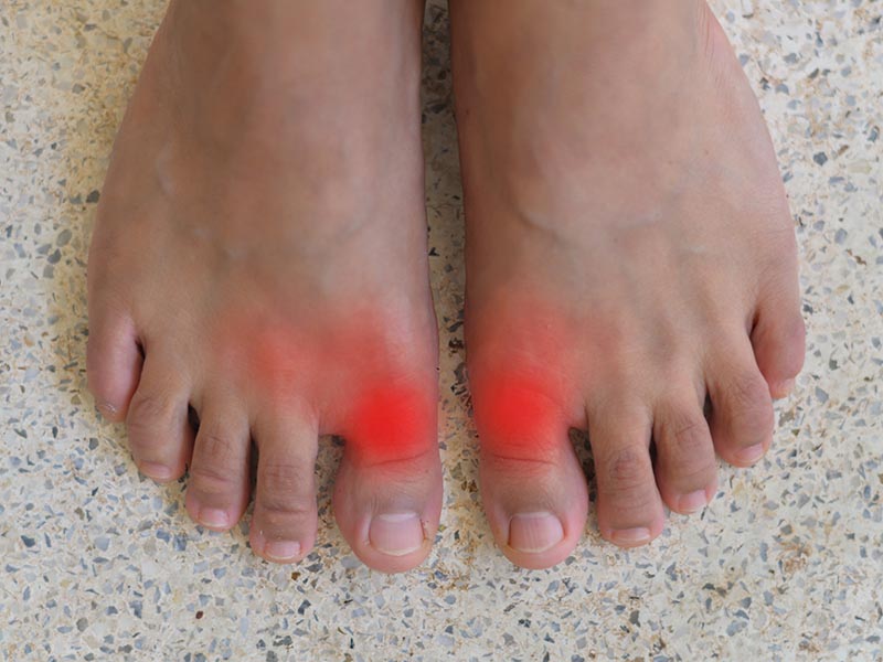 高尿酸血症・痛風 Hyperuricemia・Gout